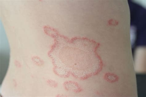 micosis en la piel-4